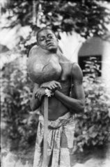 afrikanischer Mann mit riesigem Geschwuer