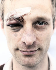 Mann mit verletzter Augenbraue