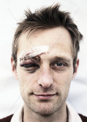 Mann mit verletzter Augenbraue