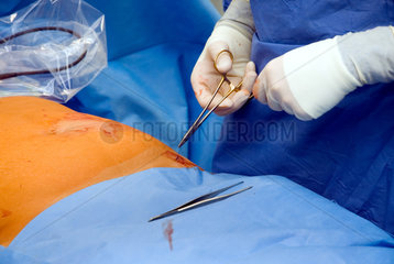 Grevenbroich  Deutschland  Chirurg naeht nach einer laparoskopischen OP eine Wunde