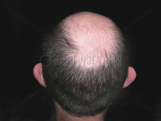 man with baldhead
