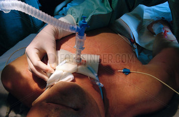 Befestigen der Beatmungskanuele an einem Patienten auf einer Intensivstation