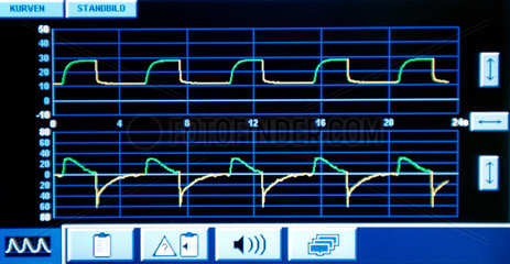 Monitoranzeige fuer Herz- und Atemfrequenz an einem Beatmungsgeraet