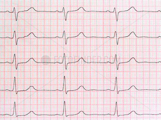 Ausdruck eines EKG  Elektrokardiogramm