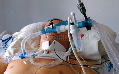 Patient mit Schlaeuchen zur Beatmung auf einer Intensivstation