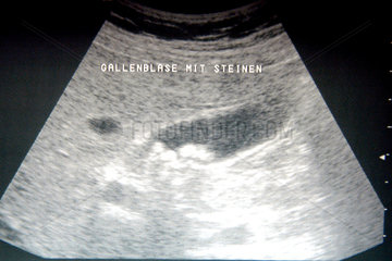 Ultraschallbild eines Gallensteins