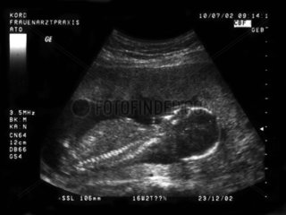 Ultraschallaufnahme eines Foetus