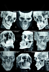 Mazar-e Sharif  Afghanistan  CT-Aufnahmen eines Kopfes