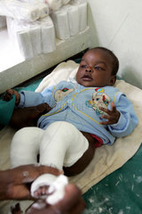 Kenia  Klumpfussbehandlung im Moi University Hospital