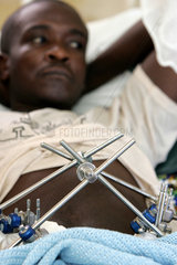 Kenia  Detail eines Fixateur externe an einem Patienten im Moi University Hospital