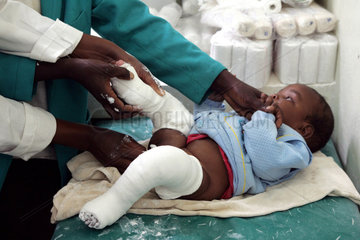 Kenia  Klumpfussbehandlung im Moi University Hospital