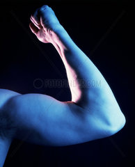 Muskuloeser Arm