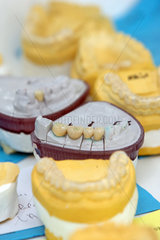 Kronen und Spangen beim Zahnarzt