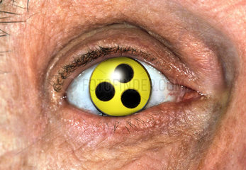 Symbolfoto blindes Auge