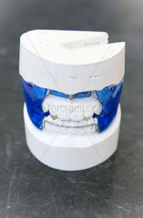 Berlin  Deutschland  Zahnspangen gegen Zahn- und Kiefer-Fehlstellungen