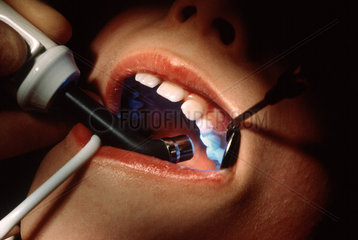 Kind beim Zahnarzt - Aushaertung mit UV-Licht