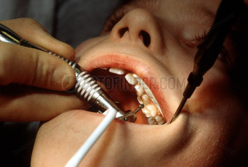 Kind beim Zahnarzt -bohren