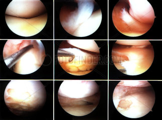 Operation am Kniegelenk - aufgenommen mit einer Endoskopkamera