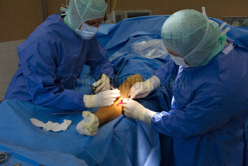 Chirurgen entfernen Titan-Platte aus Unterschenkel