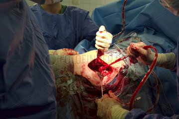 Chirurgen bei Hueft-Prothesen-Operation