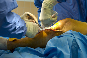 Chirurg klammert Naht am Unterschenkel