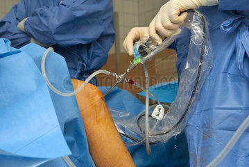 Endoskop bei Knie-Spiegelung im OP