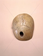 Trepanned skull  Ugandan  1925.