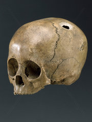Trephined human skull.