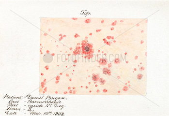 A hemorrhagic skin disease  10 March 1902.