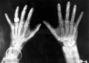 X-rays of the hands of King George and Queen Mary  1896.