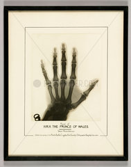 X-ray of the left hand of the Prince of Wales  1931.