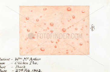 Watercolour of the skin disease chickenpox  27 February 1902.