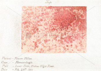 A hemorrhagic skin disease  28 February 1901.