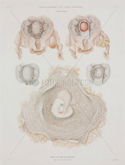 Human uterus with embryo  c 1847-1859.
