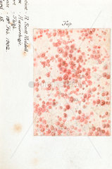 A hemorrhagic skin disease  19 February 1902.