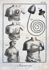 Mastectomy prosthetic  1780.