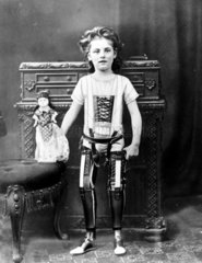 Girl wearing two artificial legs  1890-1910.