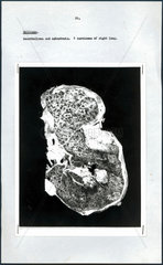 Post-mortem photograph of diseased lung  c 1970.