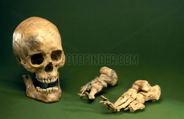 Skull and foot bones from a leper.