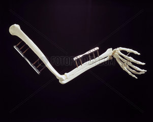 Skeletal arm with diamond-coated steel screws  1998.
