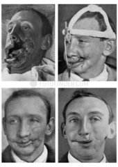 Four views of facial reconstruction after a war wound  July 1916.