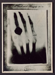 Radiograph of a hand with a ring  1895.
