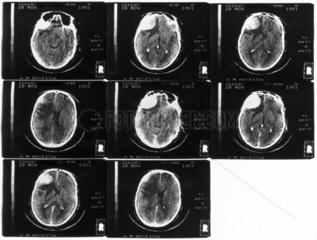 Brain scans  Atkinson Morley's Hospital  London  20 November 1981.