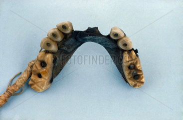 Complete upper denture  1840-1880.
