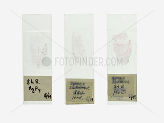 Slides of lung tissue from Dr P C Elmes' slide cabinet  c 1969.
