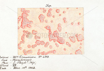 A hemorrhagic skin disease  18 March 1902.