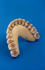 Complete upper denture  1770-1850.