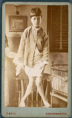 Child with rickets  1870-1910.