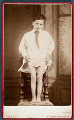 Child with rickets  1870-1910.