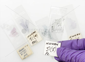 Slides of lung tissue from Dr P C Elmes' slide cabinet  c 1965.